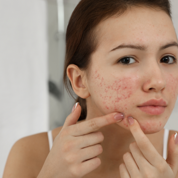 AviClear: The Ultimate Acne Solution