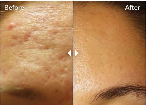 Transform your Skin with Microneedling